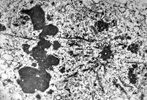 M,59y. | mitosis - angiomatous tumor, Kaposi sarcoma v.s.